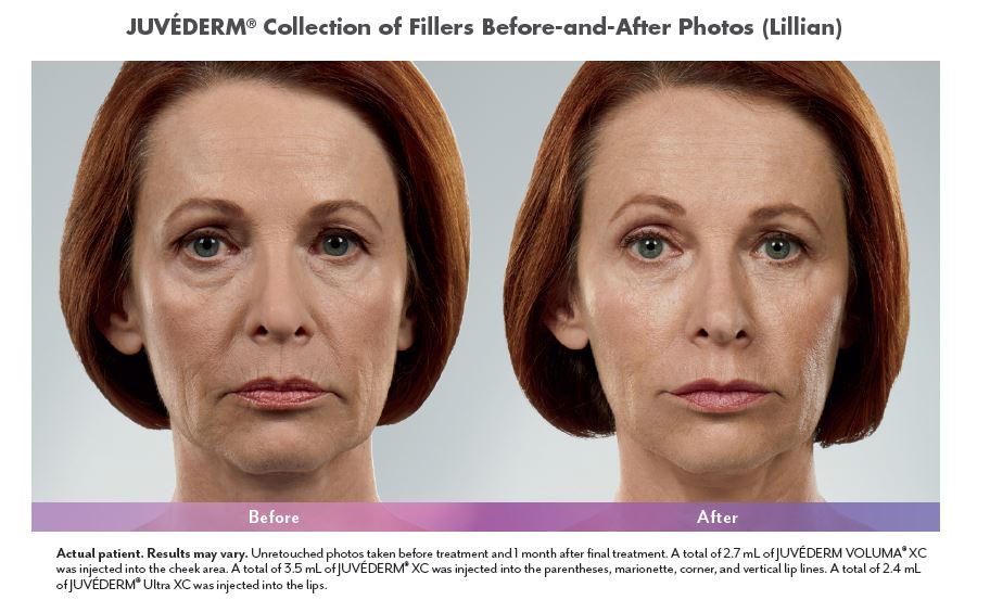 Juvederm Before and After Pictures Biloxi, MS