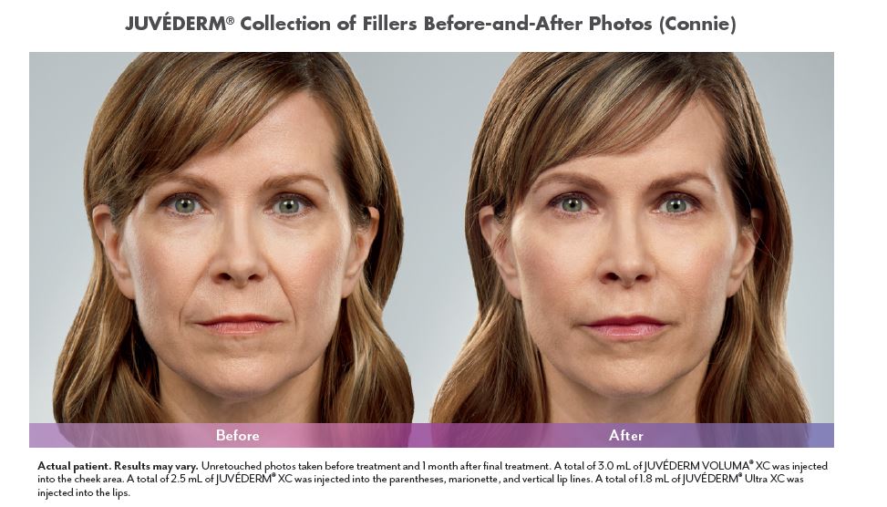 Juvederm Before and After Pictures Biloxi, MS