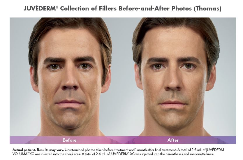 Juvederm Before and After Pictures Biloxi, MS