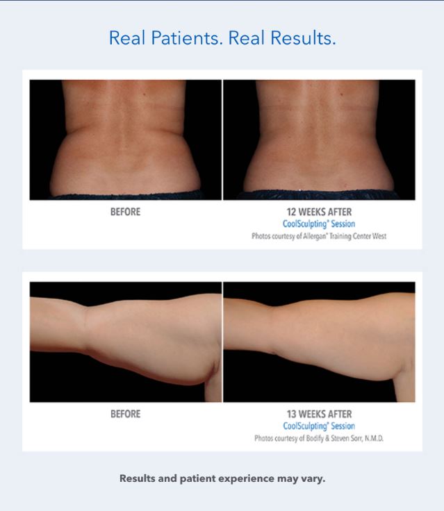 Coolsculpting B&A