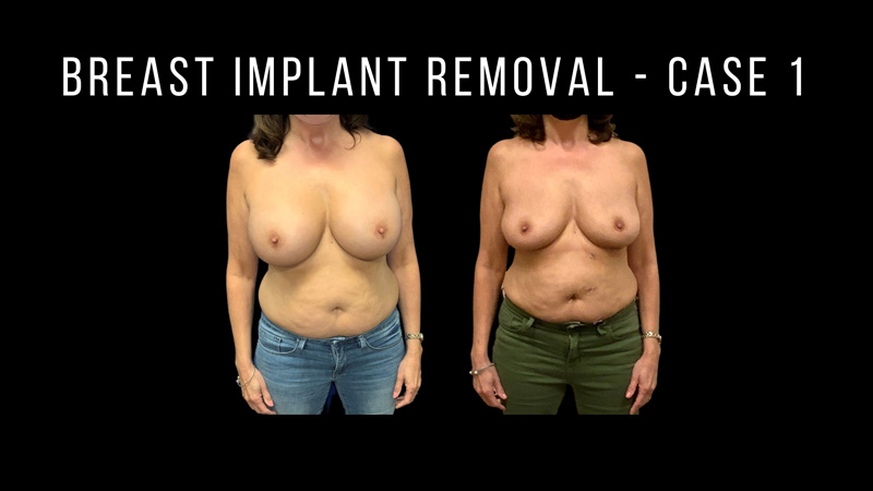 Breast Implants Pictures in Biloxi, MS