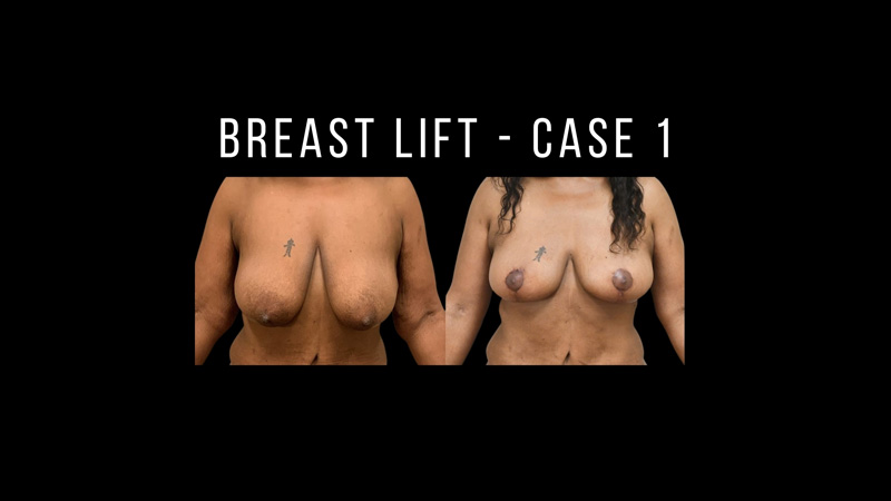 Breast Lift Pictures in Biloxi, MS