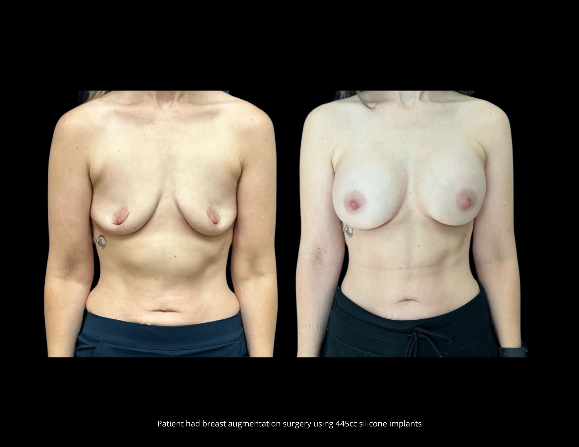 Breast Augmentation Pictures in Biloxi, MS