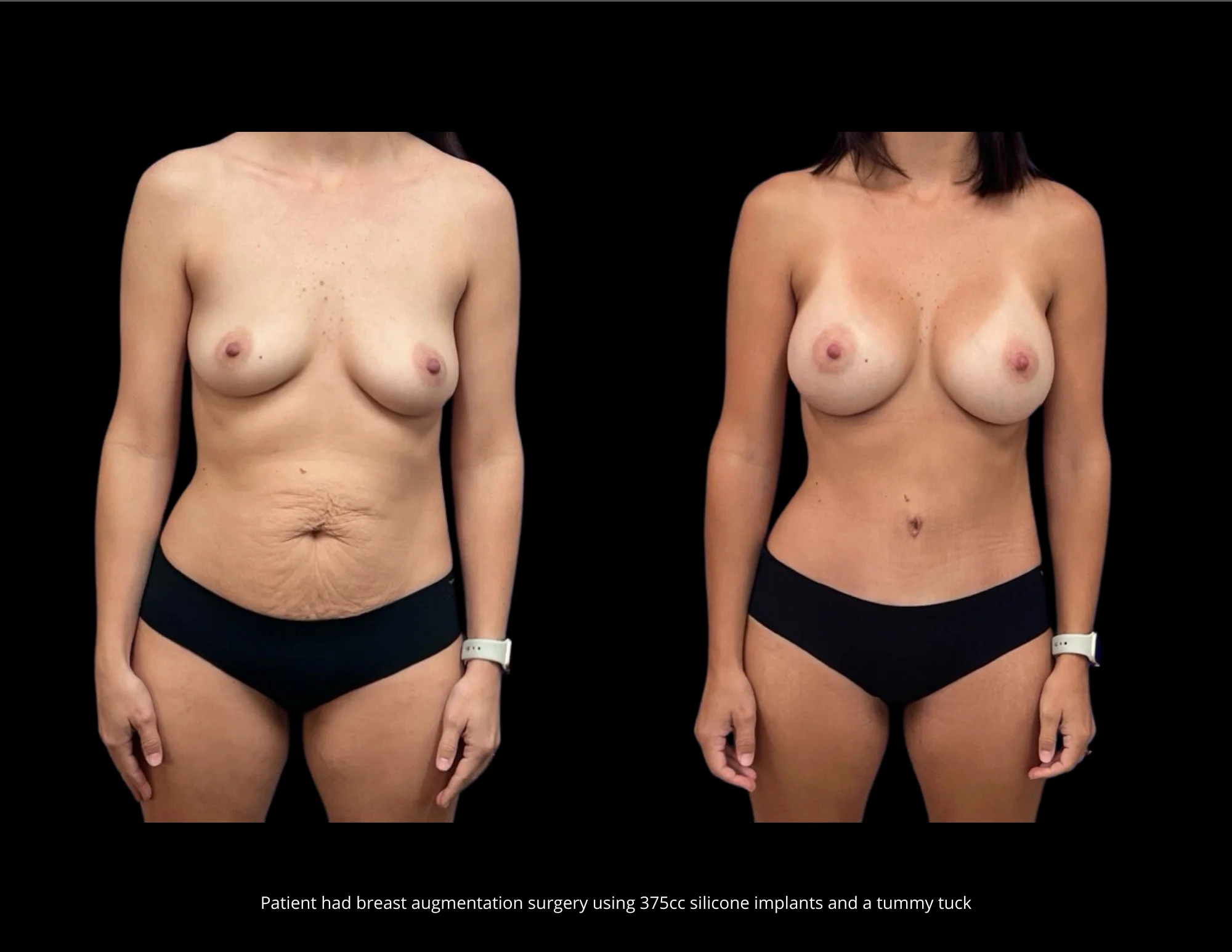 Breast Augmentation Pictures in Biloxi, MS