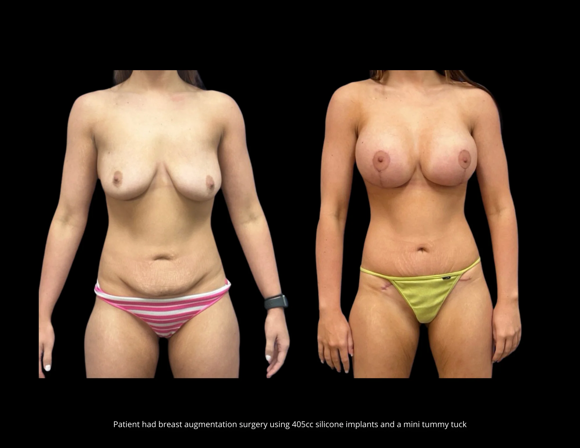 Breast Augmentation Pictures in Biloxi, MS