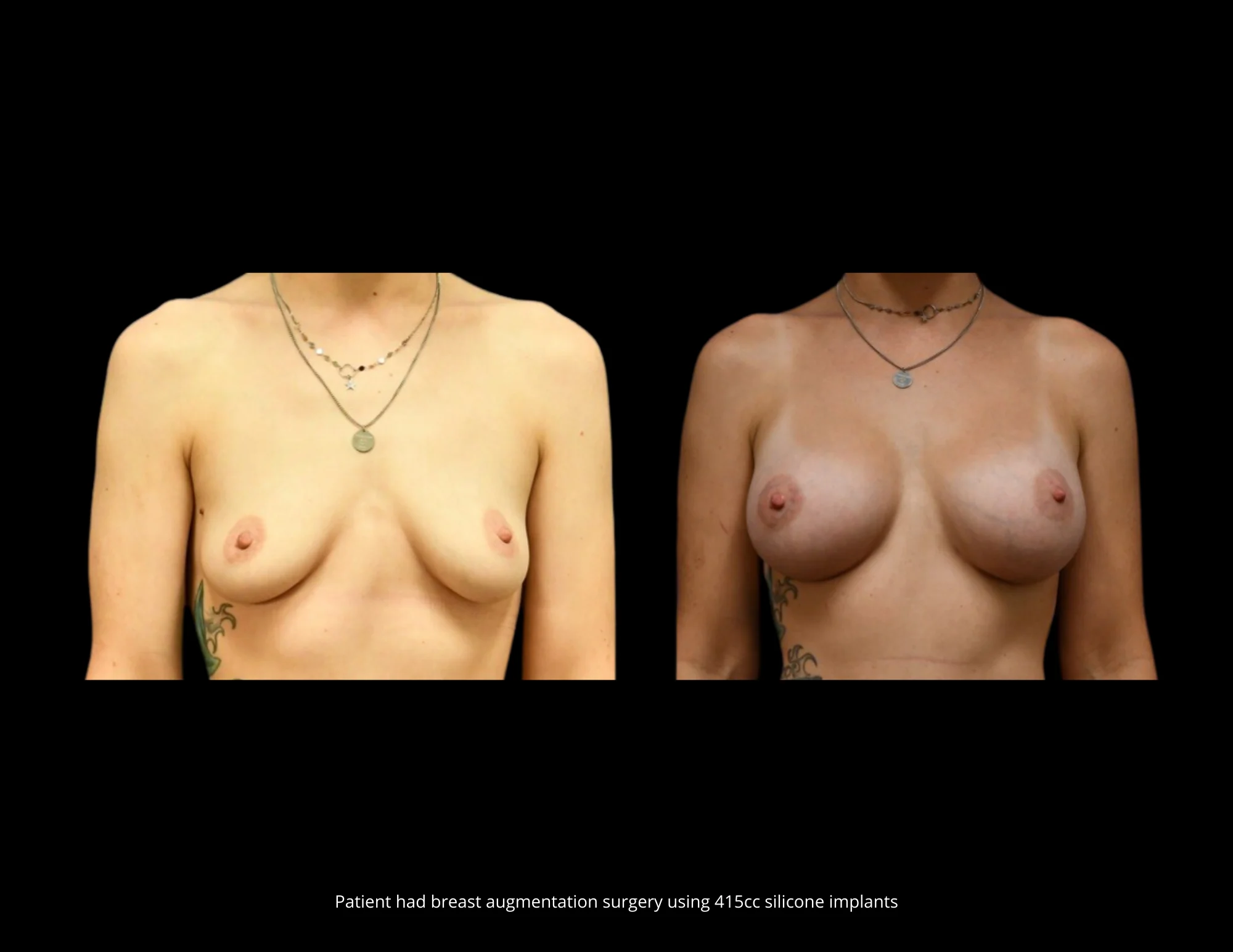 Breast Augmentation Pictures in Biloxi, MS