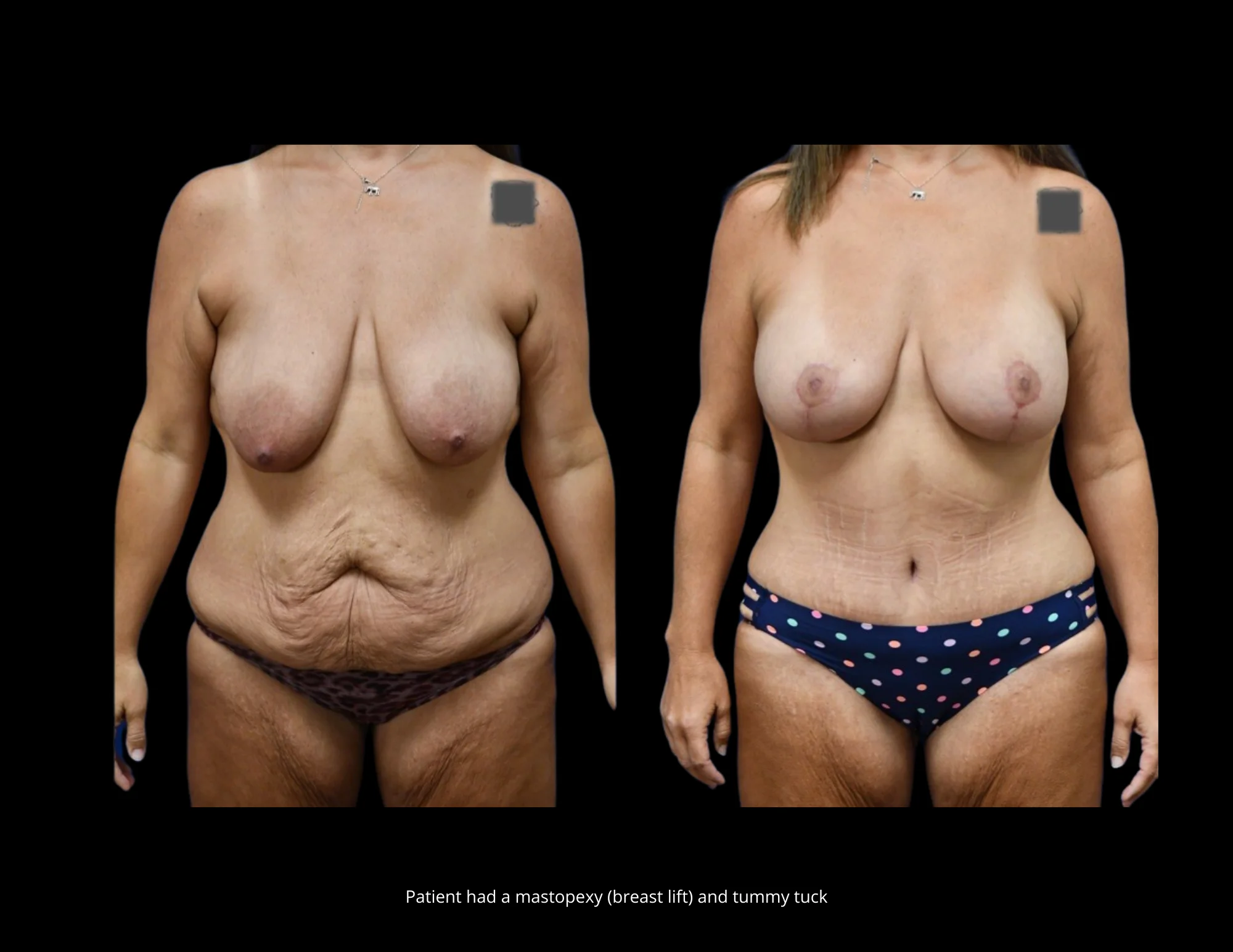 Breast Lift Pictures in Biloxi, MS