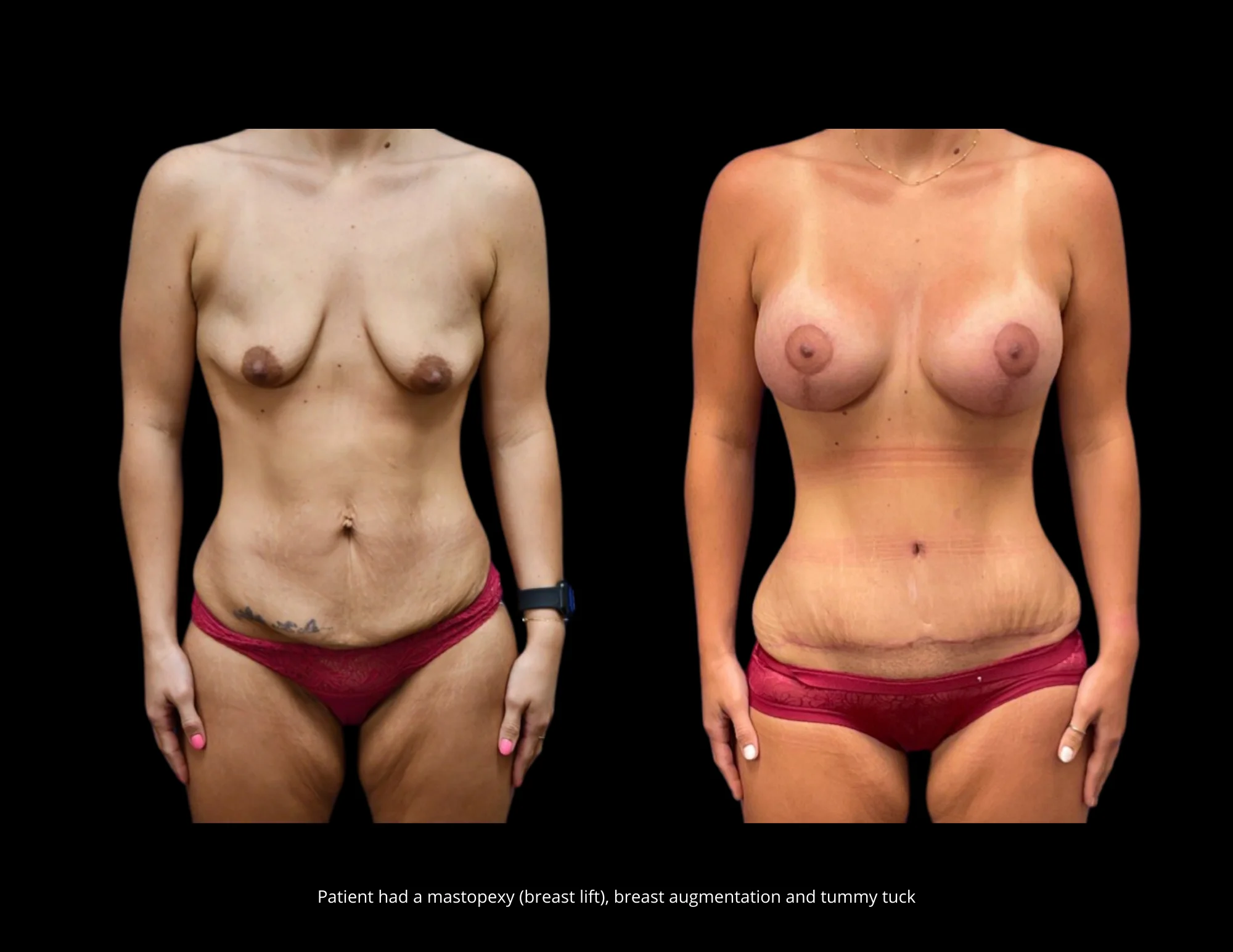 Breast Lift Pictures in Biloxi, MS