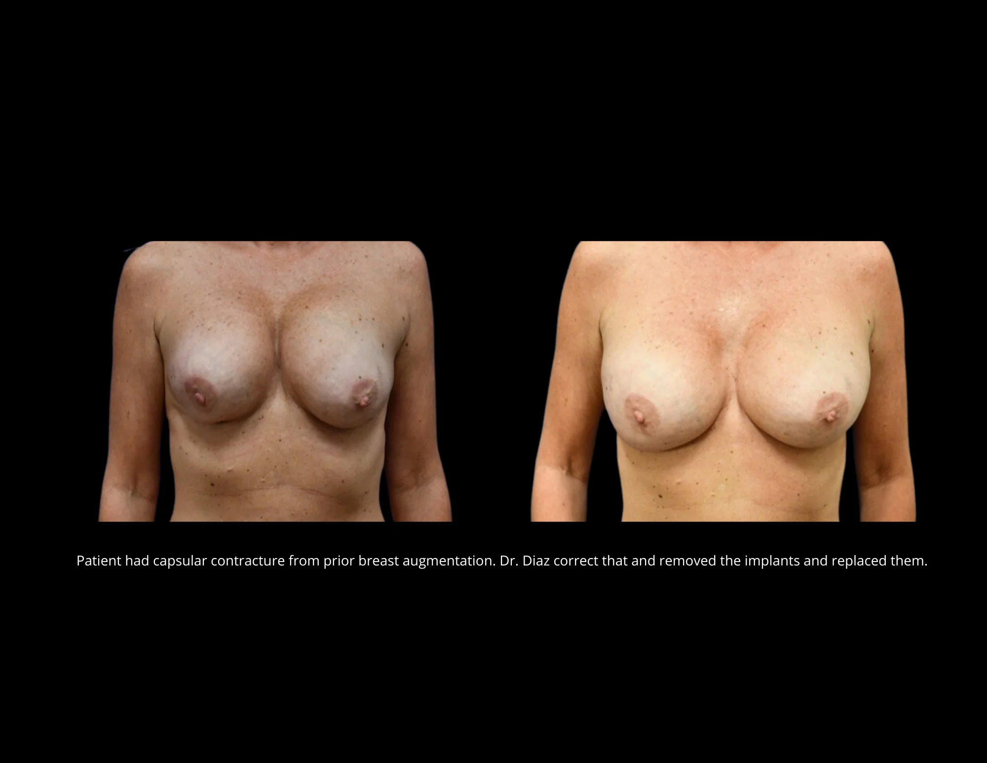 Breast Lift Pictures in Biloxi, MS