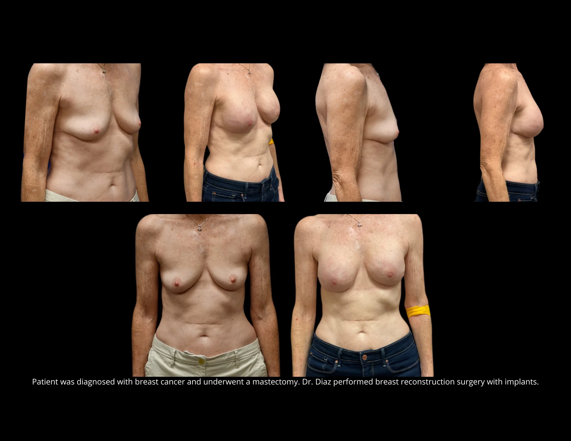 Breast Reconstruction Pictures in Biloxi, MS