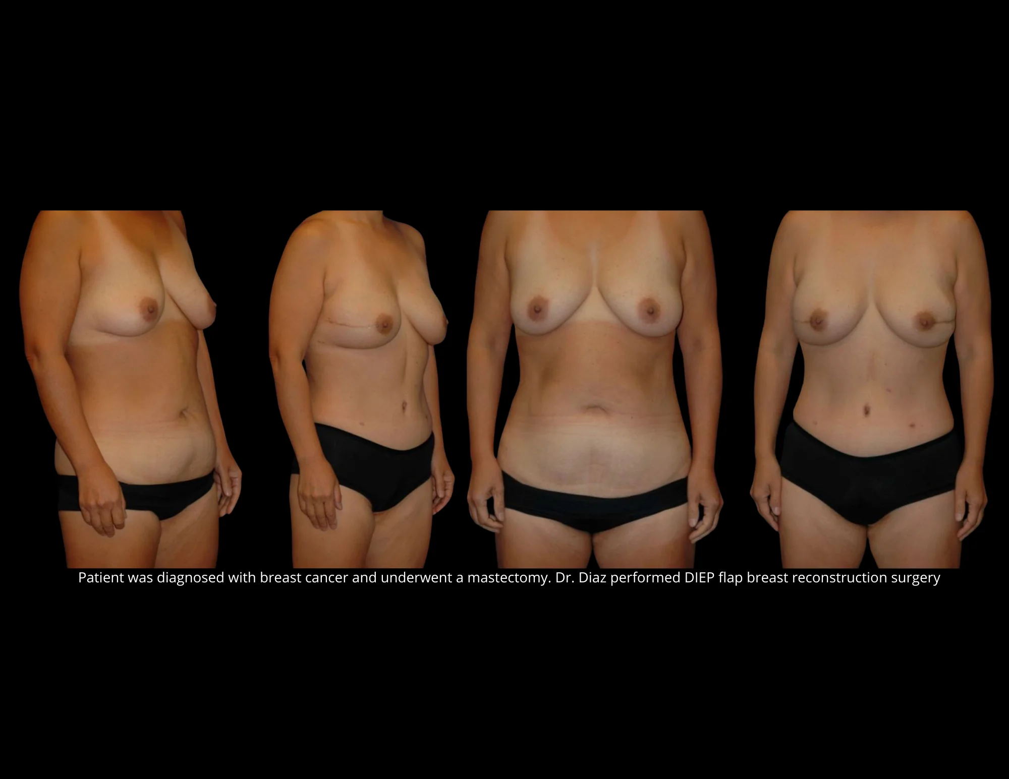 Breast Reconstruction Pictures in Biloxi, MS