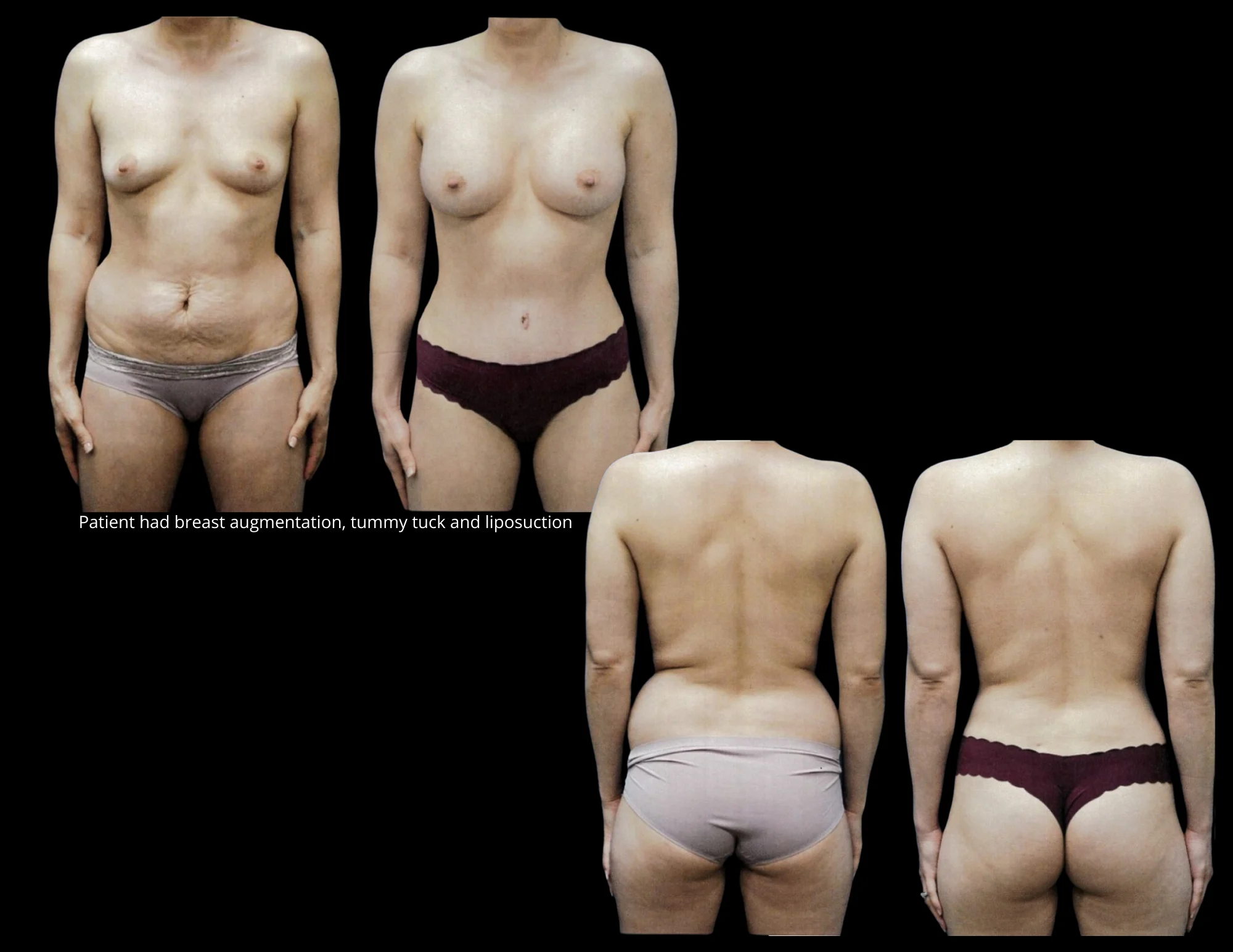 Liposuction Before and After