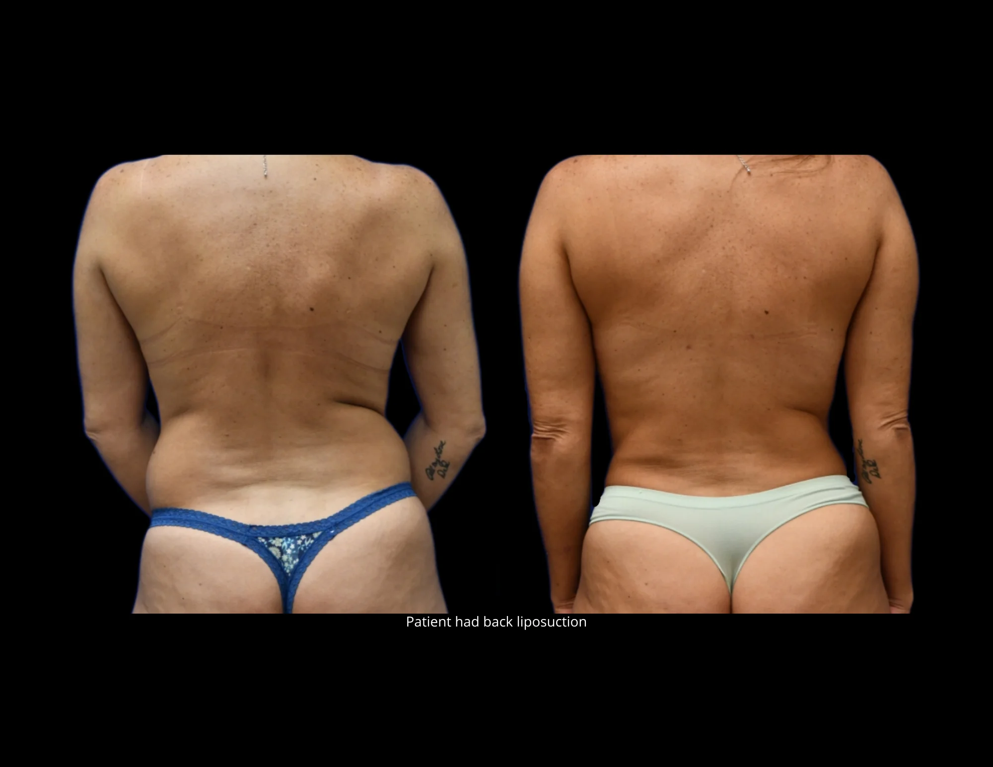 Liposuction Before and After