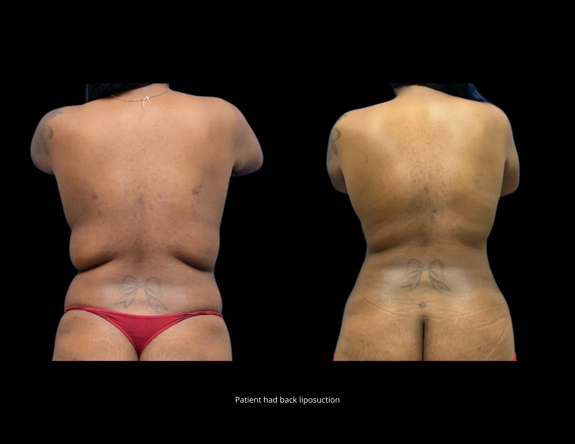 Liposuction Before and After