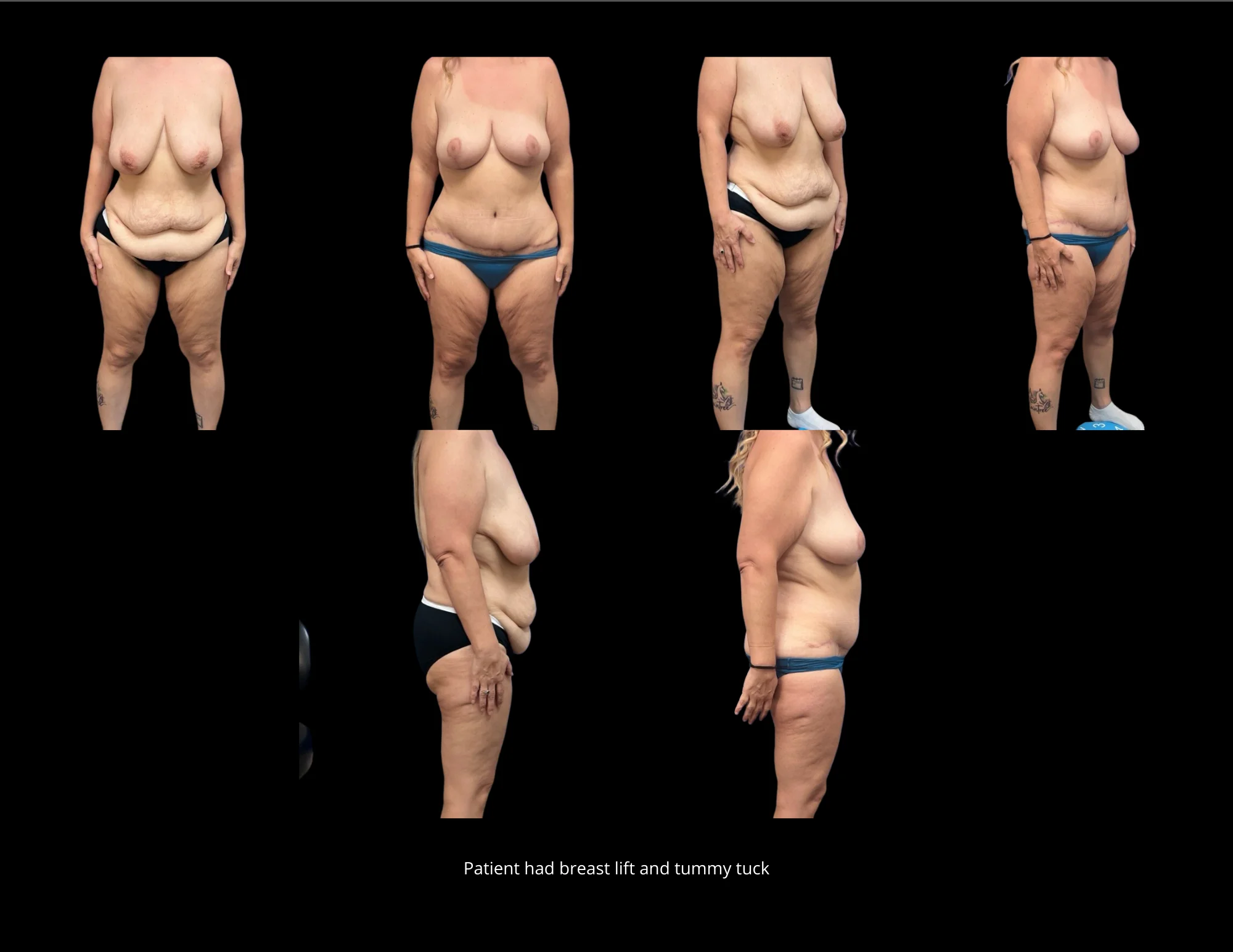 Tummy Tuck Pictures in Biloxi, MS